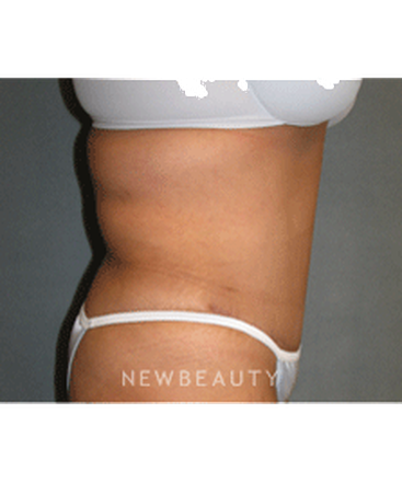 dr-sean-simon-tummy-tuck-lipo-b