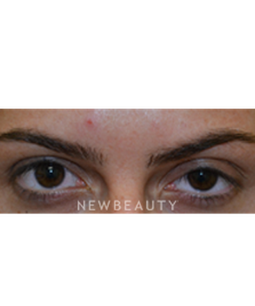 dr-baljeet-purewal-browlift-b