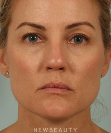 dr-kenneth-beer-natural-looking-rejuvenation-b