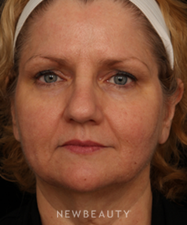 dr-jennifer-m-segal-facial-rejuvenation-b