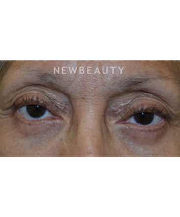 dr-baljeet-k-purewal-blepharoplasty-b