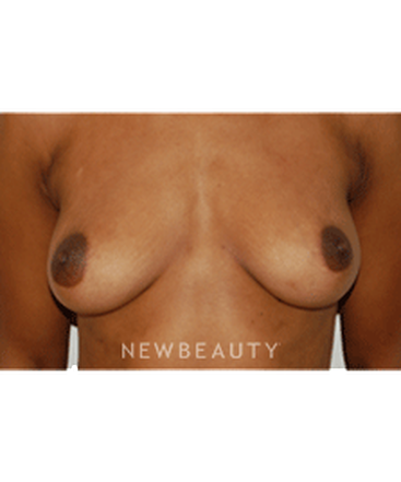 dr-david-rapaport-breast-augmentation-b