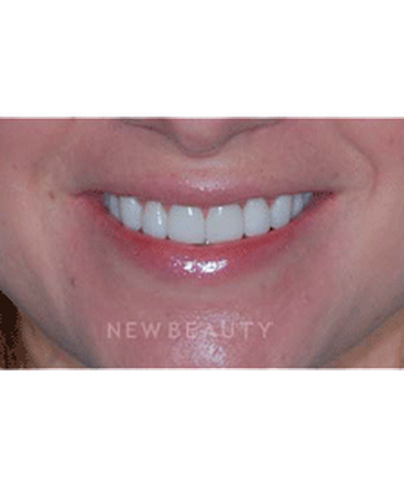 dr-guy-lewis-veneers-b