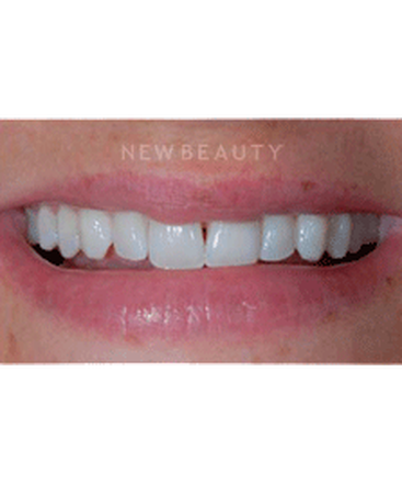 dr-guy-lewis-veneers-b