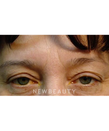 dr-baljeet-purewal-upper-blepharoplasty-b