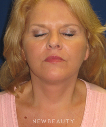 dr-dilip-d-madnani-facelift-necklift-b