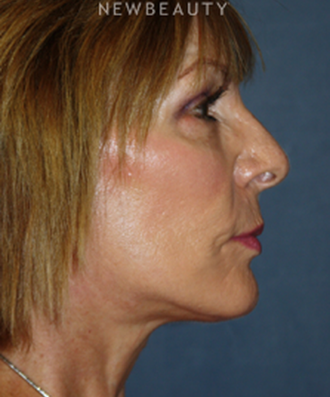 dr-brent-smith-facelift-with-fat-transfer-b