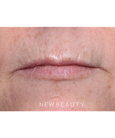 la-jolla-cosmetic-surgery-lip-lift-b