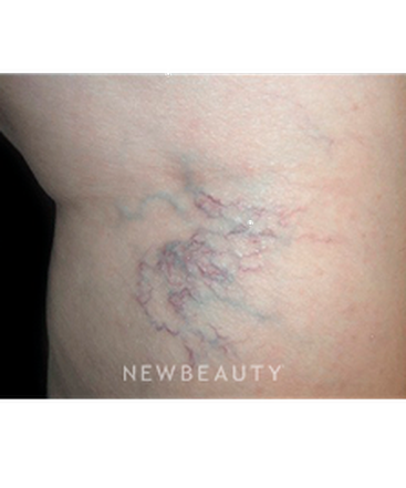 dr-marina-peredo-vein-treatment-b