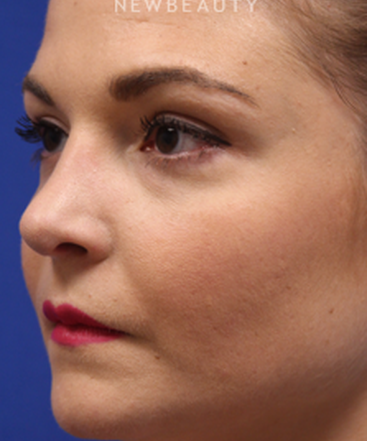 dr-jennifer-levine-rhinoplasty-b