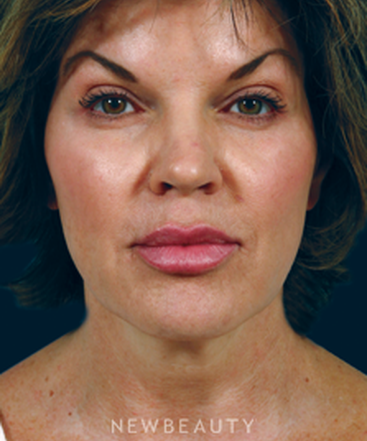 dr-kenneth-beer-restylane-b