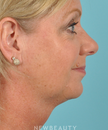 dr-bradley-bengtson-kybella-b