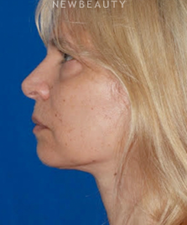 dr-konstantin-vasyukevich-upper-and-lower-blepharoplasties-b