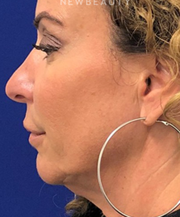 dr-dilip-madnani-facial-rejuvenation-b