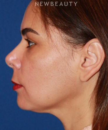 dr-dilip-d-madnani-mini-facelift-b