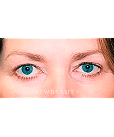 dr-sanjay-grover-blepharoplasty-b