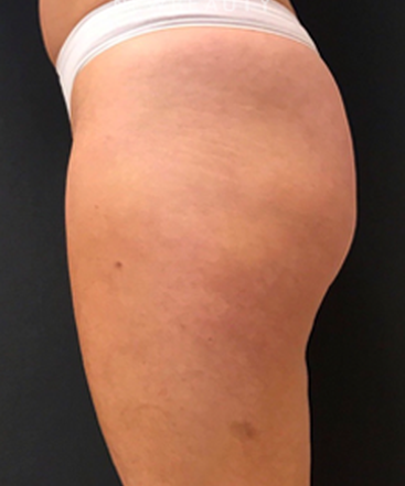 dr-janet-allenby-emsculpt-b