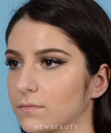 dr-jeffrey-b-wise-rhinoplasty-b