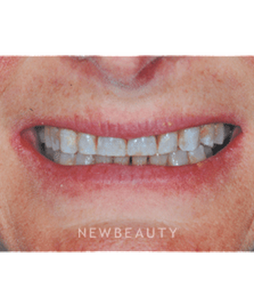 dr-guy-m-lewis-smile-makeover-b