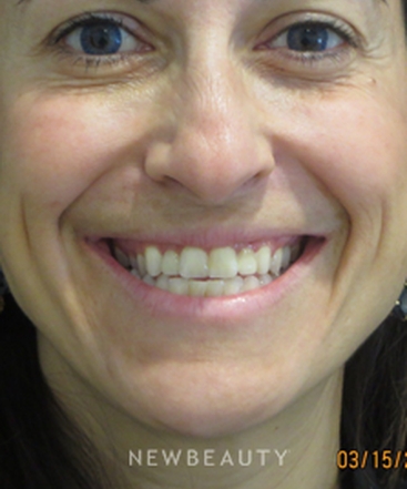 dr-kim-nichols-restylane-refyne-b