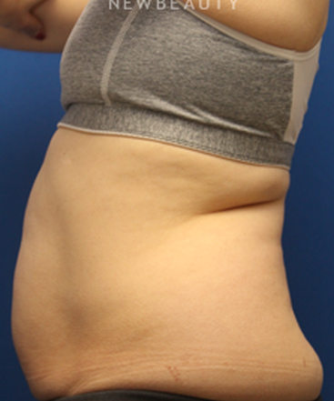 dr-jennifer-levine-sculpsure-b