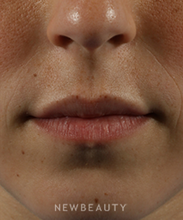 dr-marina-peredo-restylane-b