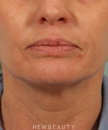dr-kenneth-beer-injectables-fillers-juvederm-b