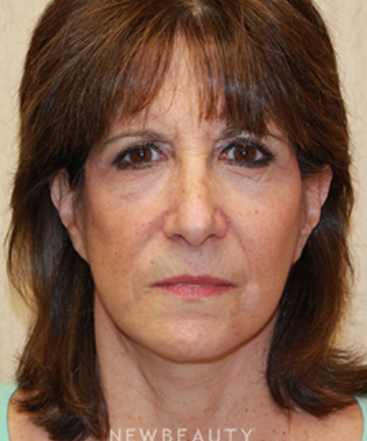 dr-dilip-d-madnani-facelift-necklift-eyelift-b