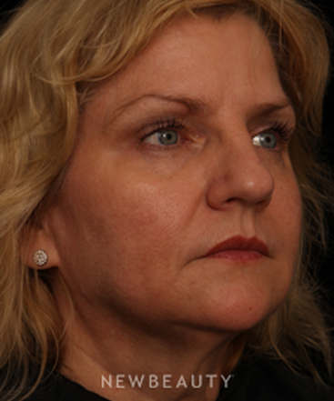 dr-jennifer-m-segal-facial-rejuvenation-b