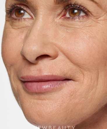 dr-marina-peredo-lip-enhancement-b