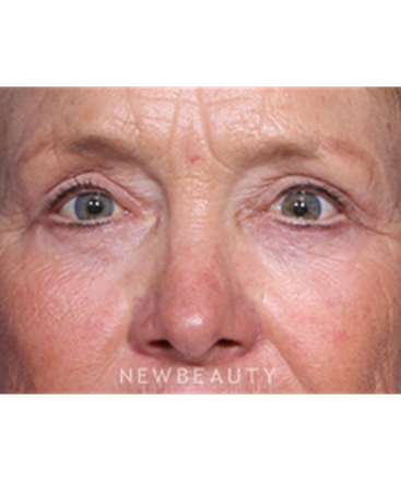 ljcsc-dr-smoot-eyelift-b