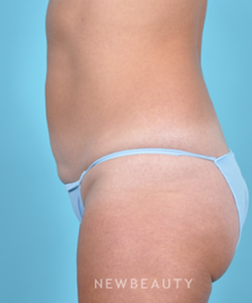 dr-bradley-bengtson-coolsculpting-b