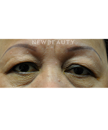 dr-baljeet-k-purewal-blepharoplasty-b