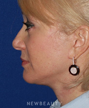 dr-konstantin-vasyukevich-facelift-b