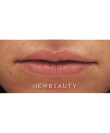 dr-kenneth-beer-lip-augmention-b