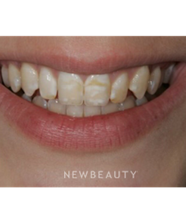 dr-laurence-rifkin-veneers-b