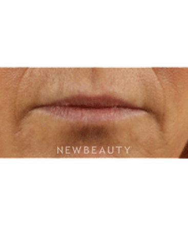 dr-marina-peredo-lip-augmentation-b