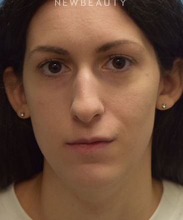 dr-jeffrey-wise-rhinoplasty-b