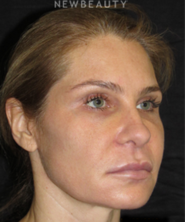 dr-joseph-grzeskiewicz-macs-facelift-b