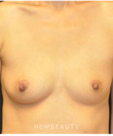 dr-andrew-smith-breast-augmentation-b