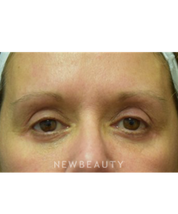dr-jeffrey-b-wise-blepharoplasty-b