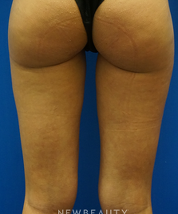 dr-niki-christopoulos-liposuction-b