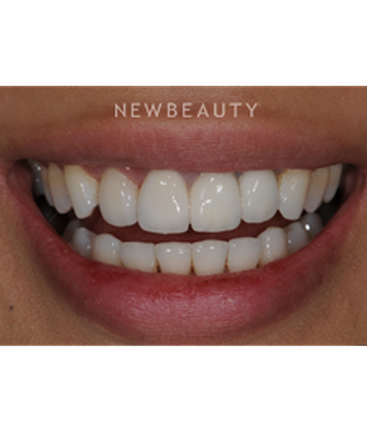 dr-ronald-goldstein-smile-makeover-b