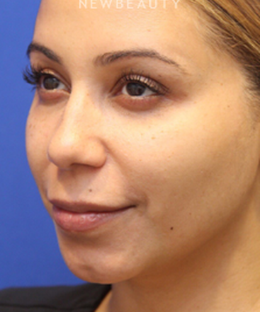 dr-jennifer-levine-liquid-facelift-b