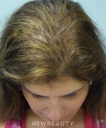 dr-jeffrey-b-wise-hair-transplant-b