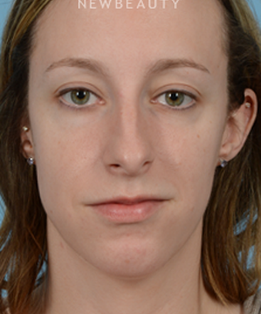 dr-jeffrey-wise-rhinoplasty-b