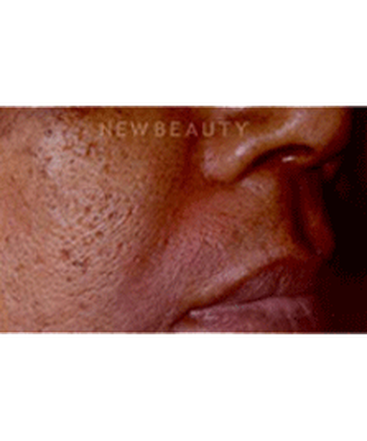 dr-charles-crutchfield-aesthetic-injectables-b