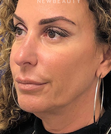 dr-dilip-madnani-facial-rejuvenation-b