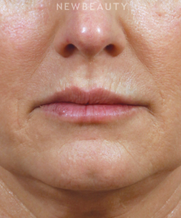 dr-kenneth-beer-lip-filler-b