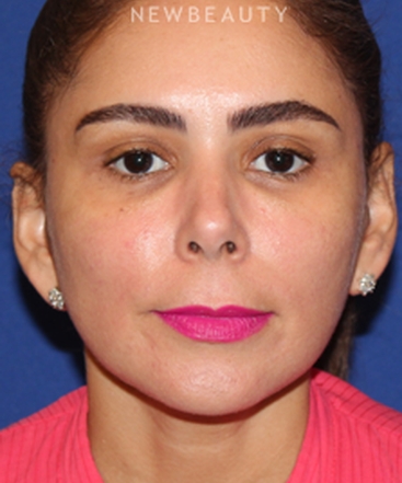 dr-dilip-d-madnani-mini-facelift-b